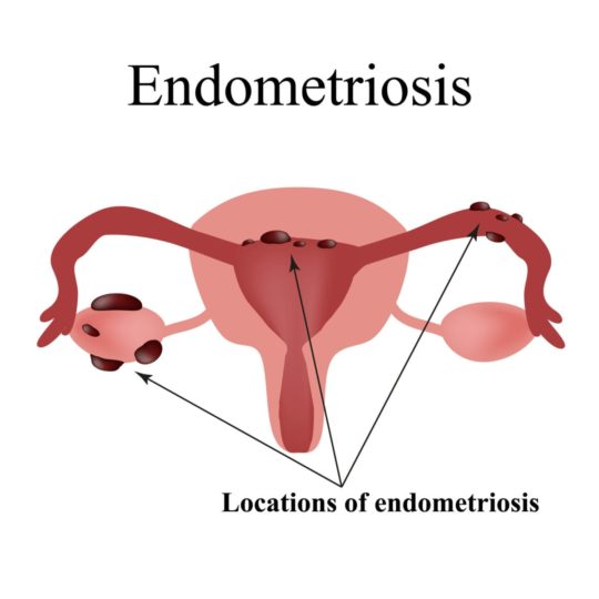 Endometriosis